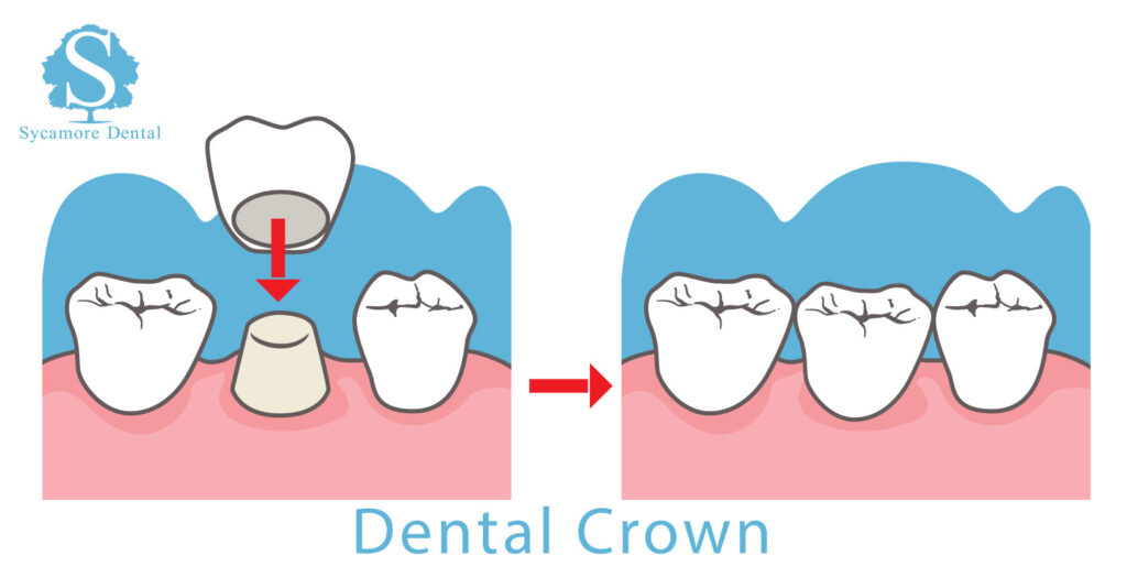 Dental Crowns, Bury St Edmunds
