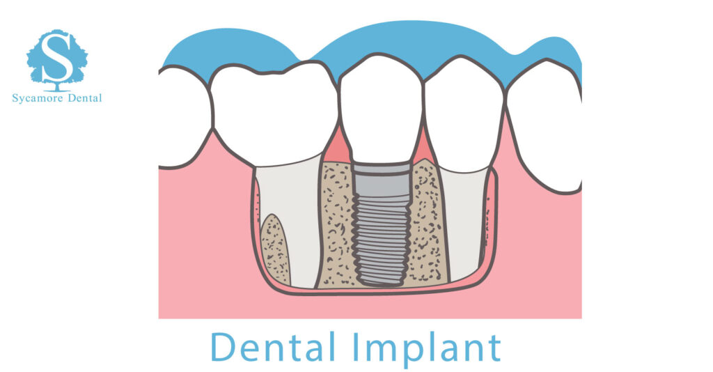 Dental Implants, Bury St Edmunds