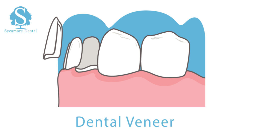 Dental Veneers, Bury St Edmunds